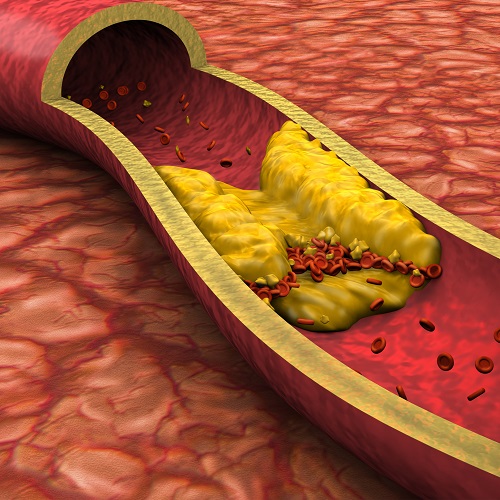 High cholesterol: Keeping it in check